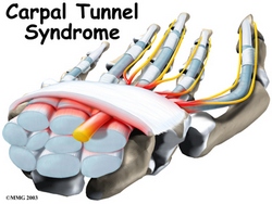 carpal tunnel symptons image